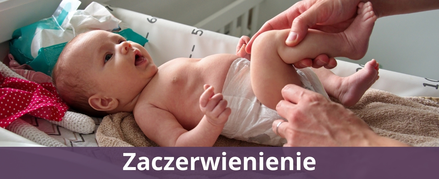 Zaczerwienienie